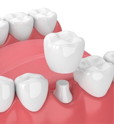 3 D illustration of dental crown