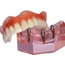 Model of implant denture