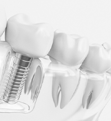 3 D illustration of a dental implant abutment crown and the smile