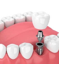 3 D illustration of a dental implant abutment and crown
