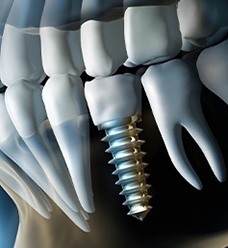 Diagram of X ray of dental implant in Jacksonville after placement