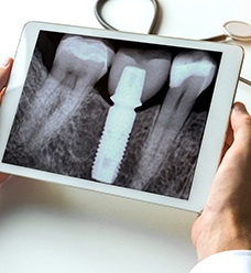 Dentist holding X ray of dental implant after bone grafting in Jacksonville