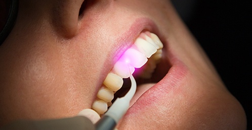 A dentist using a dental laser on a patient