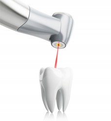 A diagram of a dental laser pointed at a tooth