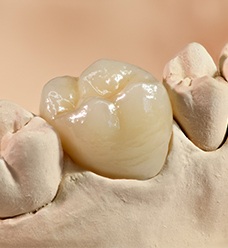 dental implant