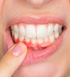 Person pointing to their red inflamed gums