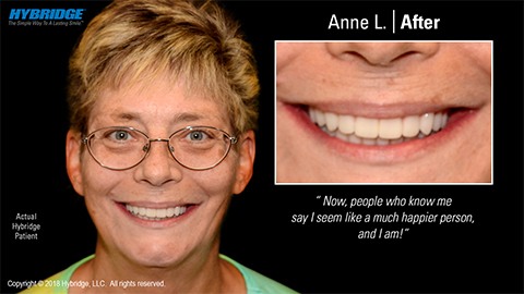 Woman smiling after All on 4 dental implants