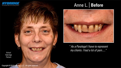 Woman smiling before All on 4 dental implants