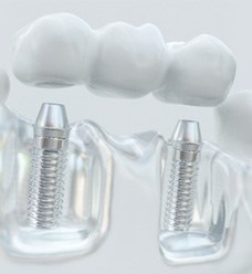 Implant Bridge in Jacksonville, FL