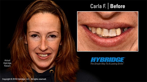 Woman smiling before All on 4 dental implants