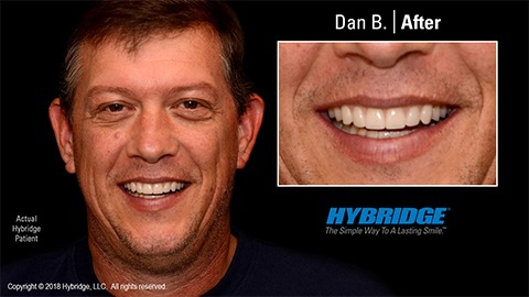 Man smiling after All on 4 dental implants