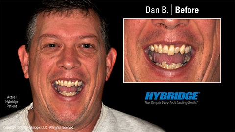 Man smiling before All on 4 dental implants