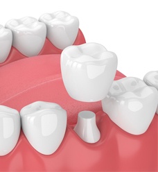 3D illustration of dental crown