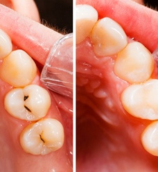 before and after tooth colored filling