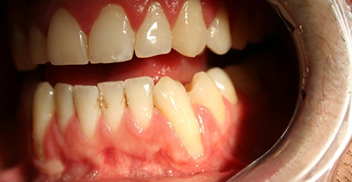 Close up of mouth with receded gums needing gum graft in Jacksonville
