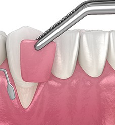 Illustration of gum grafting in Jacksonville