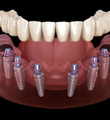 Model of how implant dentures work in Jacksonville