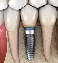 dental implant in jawbone