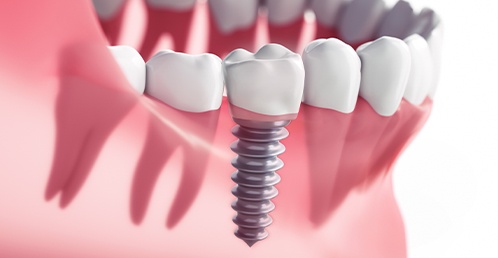 Diagram depicting dental implants in Jacksonville