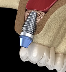 Diagram of dental implant after sinus lift in Jacksonville