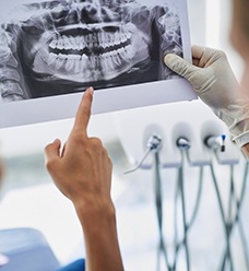 dentist explaining ridge expansion foe dental implants in Jacksonville
