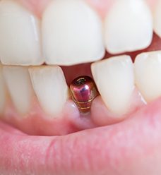 Closeup of dental implant in Jacksonville