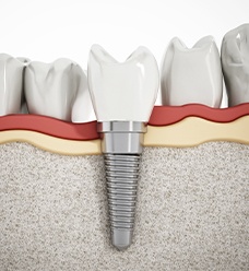Diagram of dental implant in Jacksonville after placement