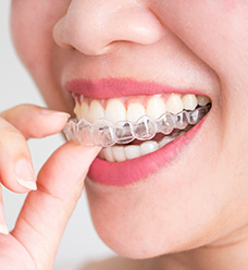 Patient placing Invisalign aligner on top row of teeth