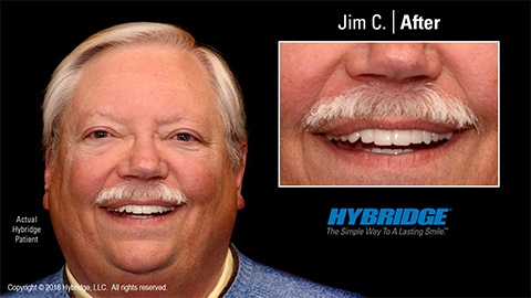 Man smiling after All on 4 dental implants