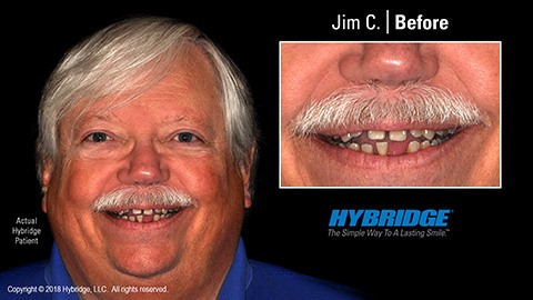 Man smiling before All on 4 dental implants