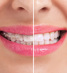 Close up of smile with one half wearing braces and the other half with Invisalign