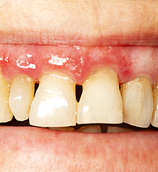 Close up of mouth with long teeth due to gum disease