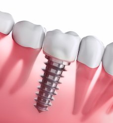 Illustrated dental implant with dental crown