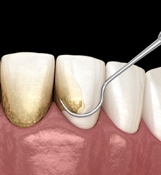 Illustration of scaling and root planing