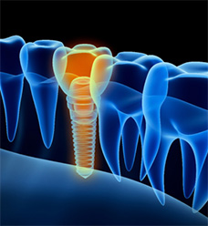 digital image of dental implant