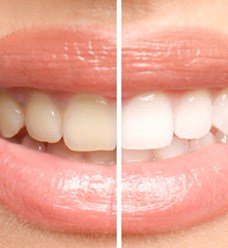 Before and after teeth whitening