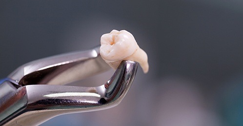 Extracted molar held by forceps