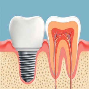 What makes a prosthodontist in Jacksonville, FL different from a regular dentist? With years of additional training, these specialists are your go-to choice for replacement teeth. 