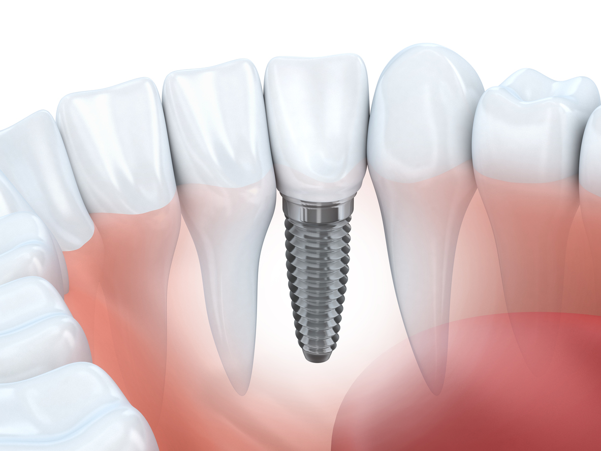 Dental implant Jacksonville Dental Specialist Blog
