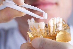 The dentist in Jacksonville does bone grafting procedures. 