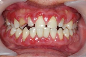 infected gum disease