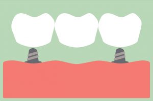 dental crowns dental bridge dental implants