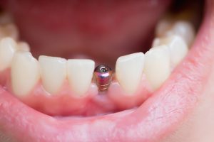 single dental implant