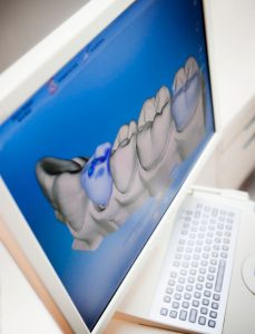 digital dental impression