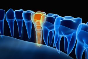 dental implant x-ray