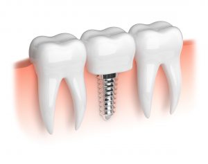 single dental implant illustration