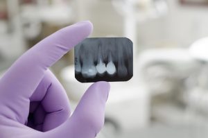 single tooth dental implant x-ray