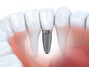 dental implant