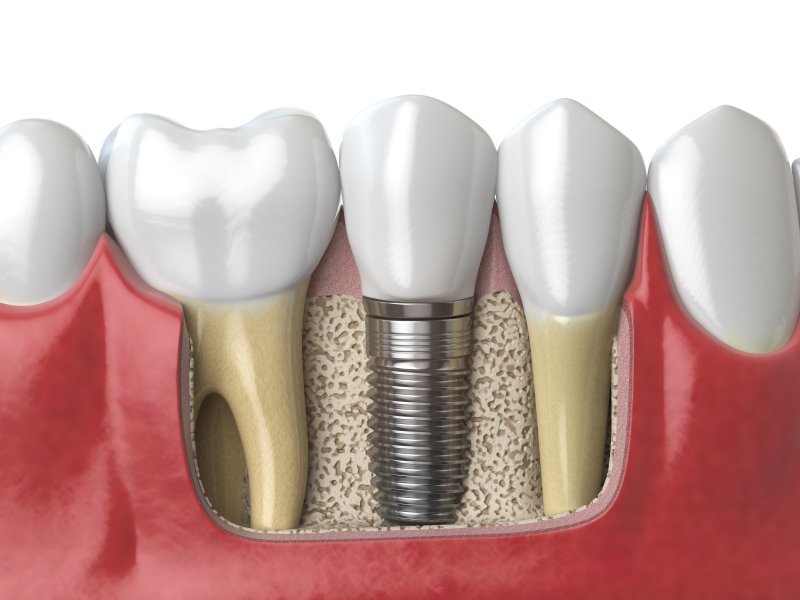 a dental implant