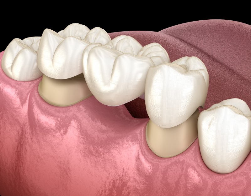 a dental bridge